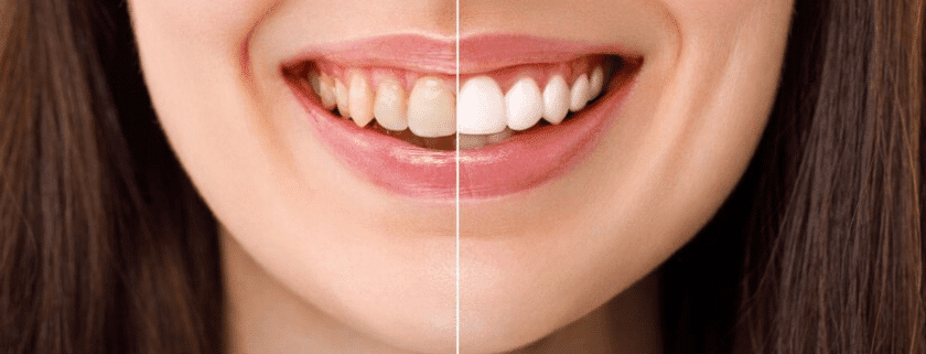 Close-up of a smile showing teeth discoloration and stains, with a focus on understanding causes and treatment options for a brighter smile.