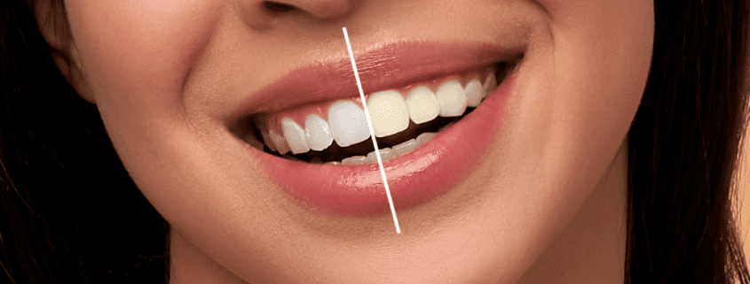 Professional teeth whitening treatment at Cedar Ridge Dental Clinic for a brighter, more confident smile.