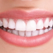 Professional teeth whitening treatment for a brighter, more radiant smile at Cedar Ridge Dental Clinic.