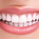 Professional teeth whitening treatment for a brighter, more radiant smile at Cedar Ridge Dental Clinic.