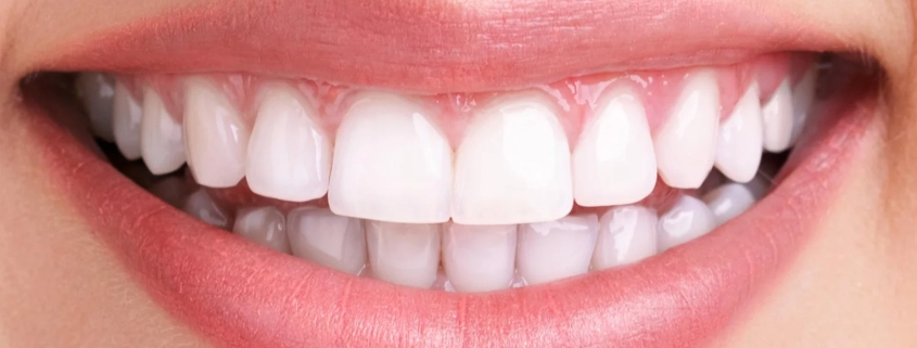 Professional teeth whitening treatment for a brighter, more radiant smile at Cedar Ridge Dental Clinic.